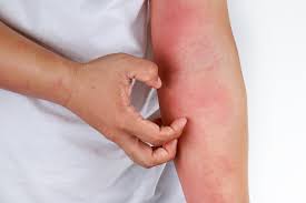 When are rashes a sign of skin cancer?