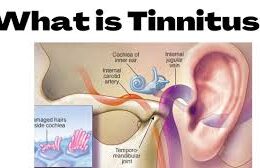 What Is Tinnitus?